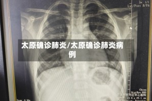 太原确诊肺炎/太原确诊肺炎病例